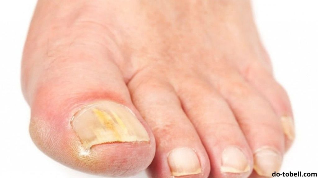 Nail Fungus